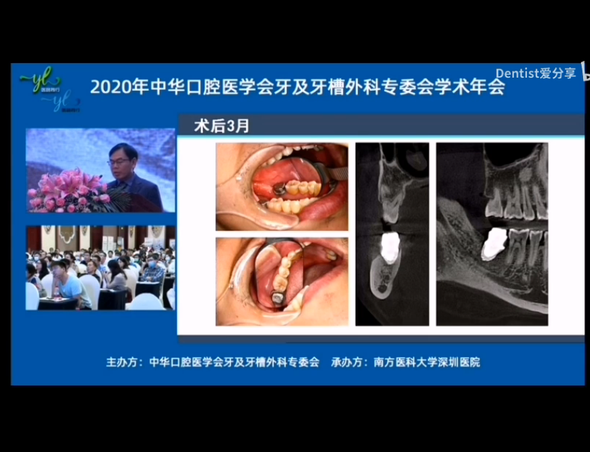 2020牙槽外科年会—牙种植术的讨论